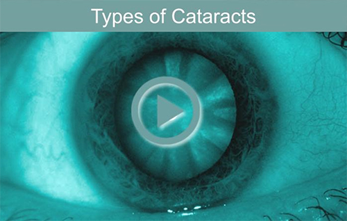 cataracts types